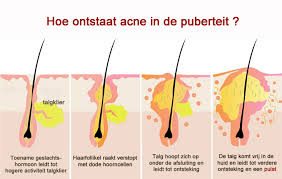 acné pubertijd