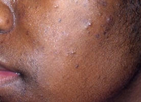 Puistjes-acne-bij-een-donkere-huid1